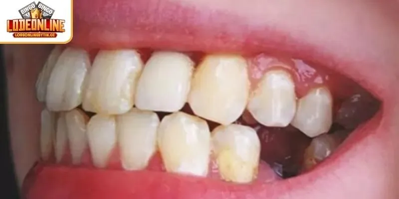 Ý nghĩa về giấc mơ thấy rụng răng không chảy máu